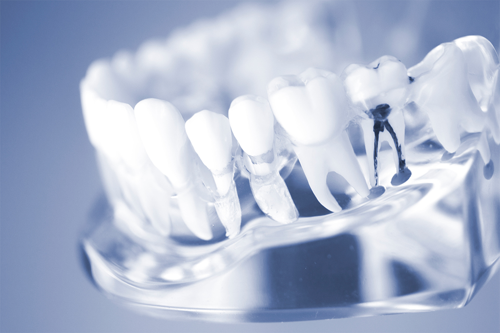 歯内治療における自由診療と保険治療の違い